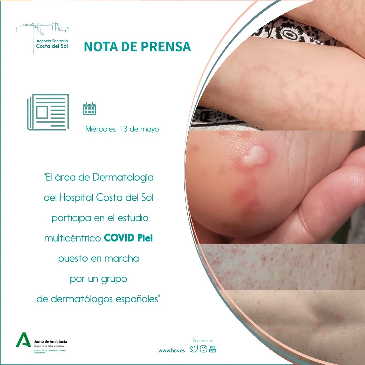 El área de Dermatología del Hospital Costa del Sol participa en el estudio multicéntrico COVID Piel puesto en marcha por un grupo de dermatólogos españoles