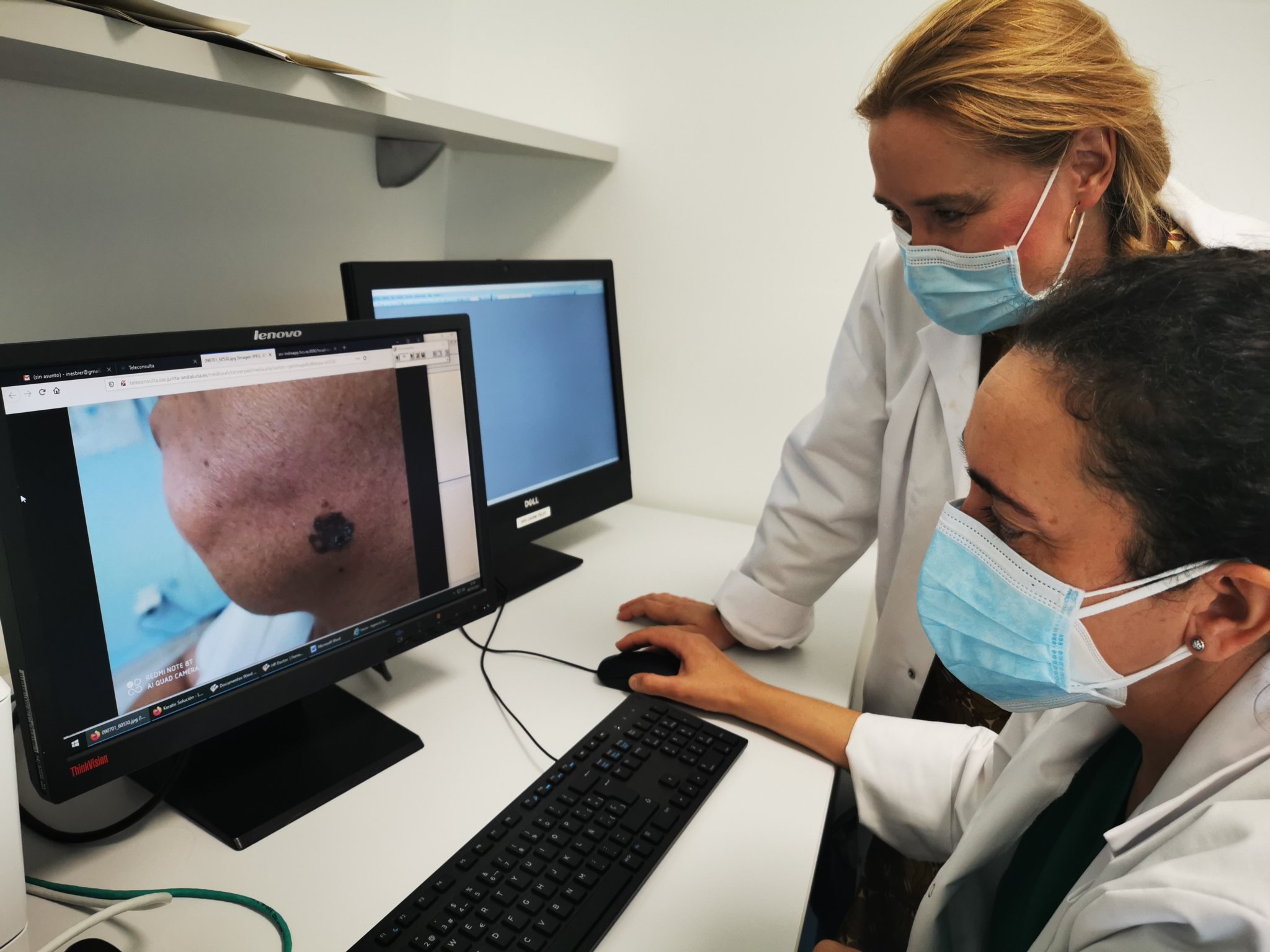 El impacto de la Covid 19 reduce en un 62% la detección precoz del melanoma en el Hospital Costa del Sol
