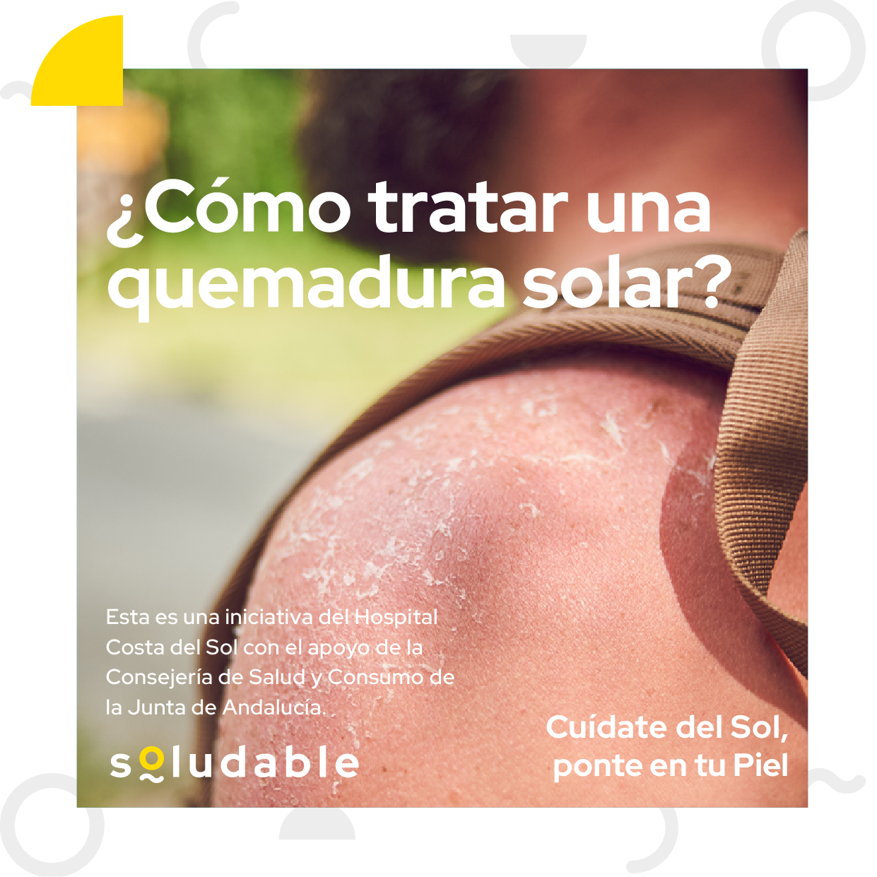 Soludable crea una guía específica con recomendaciones frente a las quemaduras solares